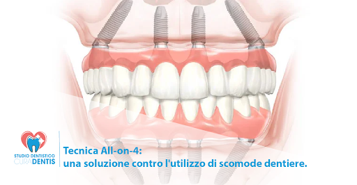 All on 4: l’implantologia che migliora la vita